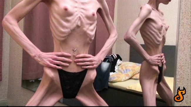 OMG of the day. Anorexia – one of the most horrible things in the world! - 02