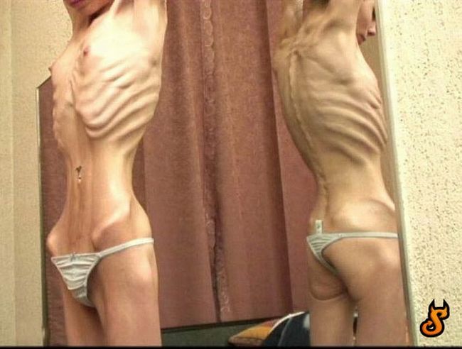 OMG of the day. Anorexia – one of the most horrible things in the world! - 04