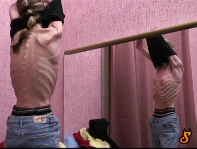 OMG of the day. Anorexia – one of the most horrible things in the world! - 05