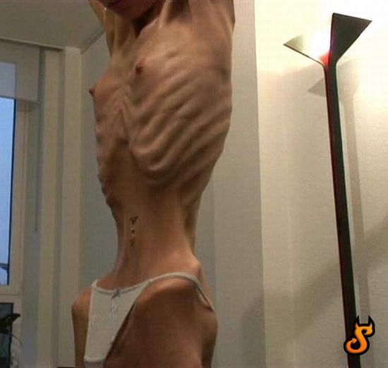 OMG of the day. Anorexia – one of the most horrible things in the world! - 06