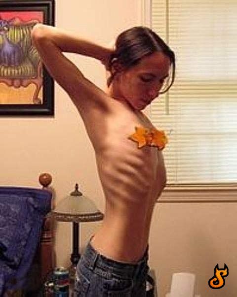 OMG of the day. Anorexia – one of the most horrible things in the world! - 08
