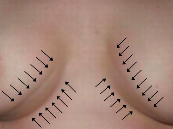 Silicone tits - this is not always good! - 11