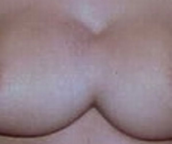 Silicone tits - this is not always good! - 14