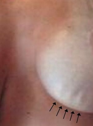 Silicone tits - this is not always good! - 16