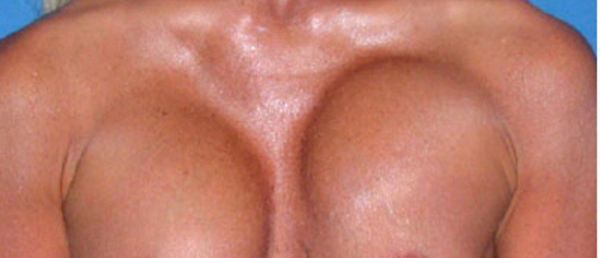 Silicone tits - this is not always good! - 17