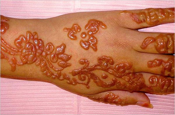 Scarring, a very weird way to “decorate” your body - 11