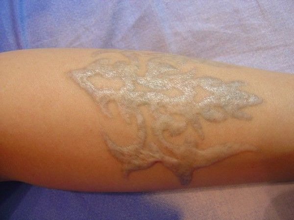 Scarring, a very weird way to “decorate” your body - 28