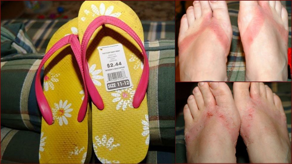 Chemical burns from sandals bought in a Wal-Mart store - 18