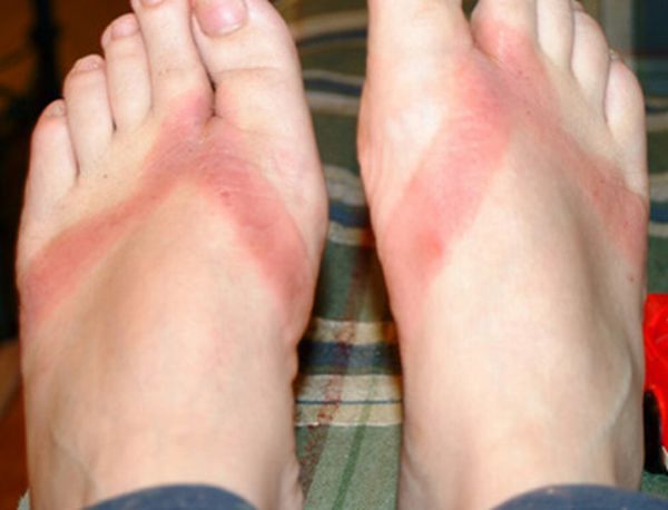 Chemical burns from sandals bought in a Wal-Mart store - 02