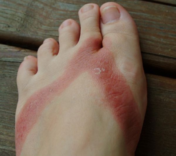 Chemical burns from sandals bought in a Wal-Mart store - 03