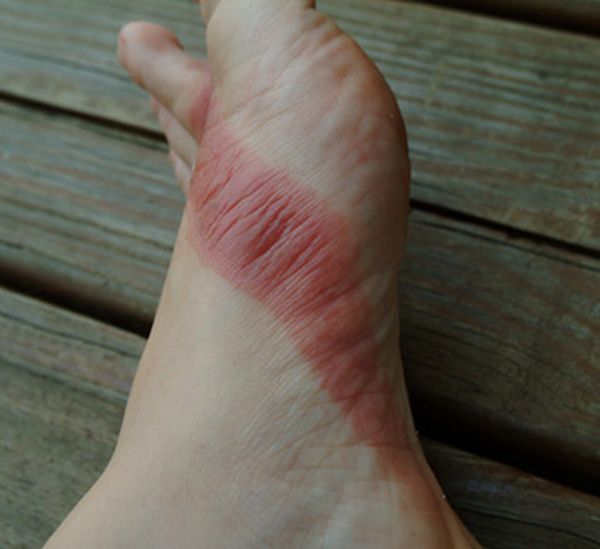 Chemical burns from sandals bought in a Wal-Mart store - 05