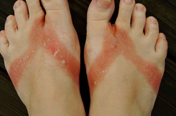 Chemical burns from sandals bought in a Wal-Mart store - 06