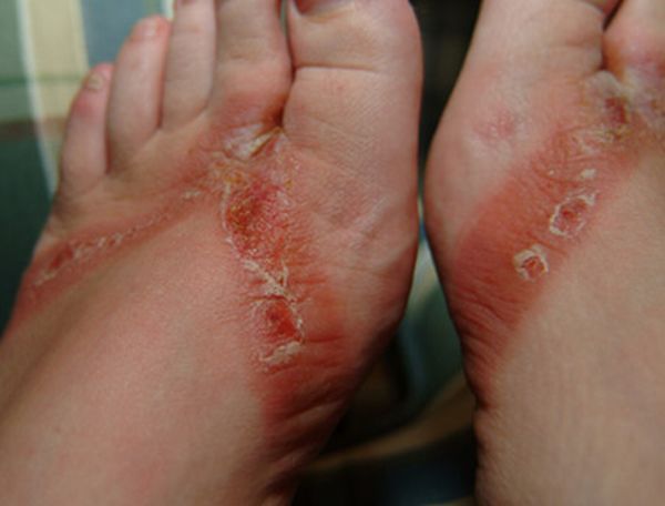 Chemical burns from sandals bought in a Wal-Mart store - 08