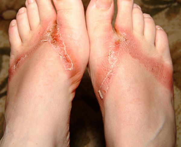 Chemical burns from sandals bought in a Wal-Mart store - 09