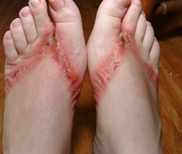 Chemical burns from sandals bought in a Wal-Mart store - 10