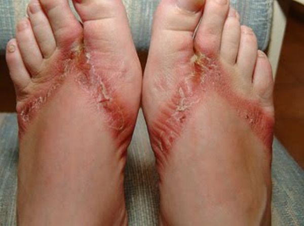 Chemical burns from sandals bought in a Wal-Mart store - 11