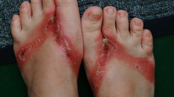 Chemical burns from sandals bought in a Wal-Mart store - 12