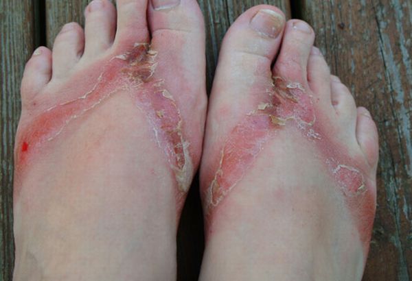 Chemical burns from sandals bought in a Wal-Mart store - 13