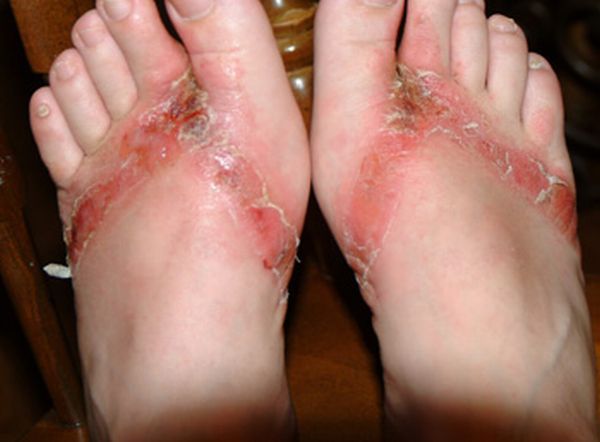 Chemical burns from sandals bought in a Wal-Mart store - 14