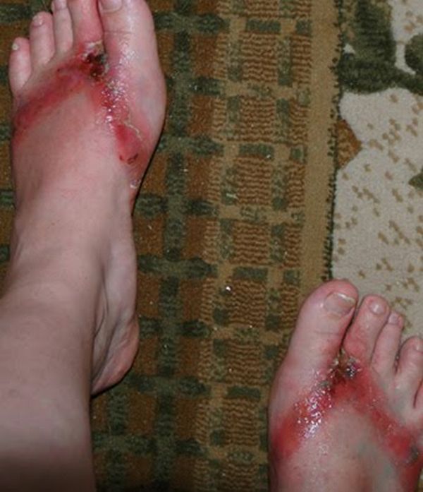 Chemical burns from sandals bought in a Wal-Mart store - 15