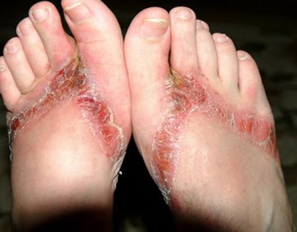 Chemical burns from sandals bought in a Wal-Mart store - 16
