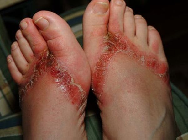 Chemical burns from sandals bought in a Wal-Mart store - 17