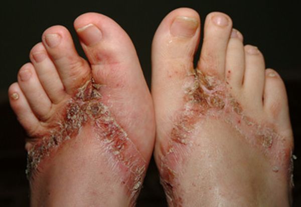 Chemical burns from sandals bought in a Wal-Mart store - 18