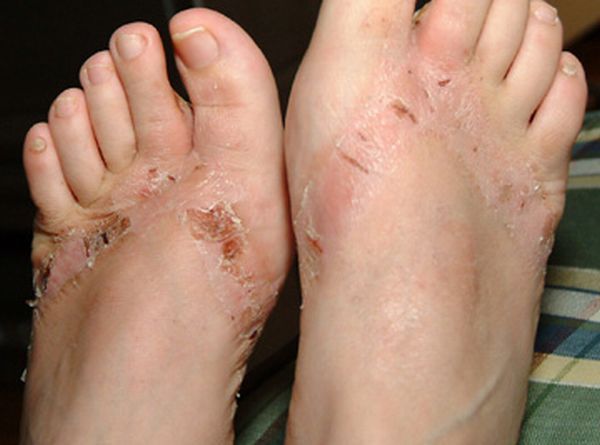 Chemical burns from sandals bought in a Wal-Mart store - 19