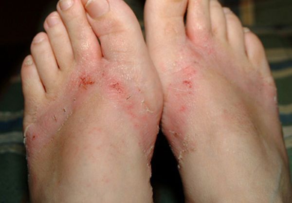 Chemical burns from sandals bought in a Wal-Mart store - 20