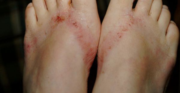 Chemical burns from sandals bought in a Wal-Mart store - 21