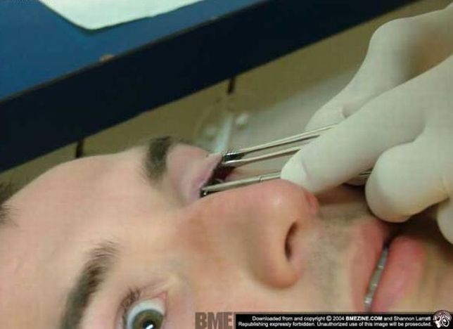 Another crazy body modification – the piercing of the century - 05