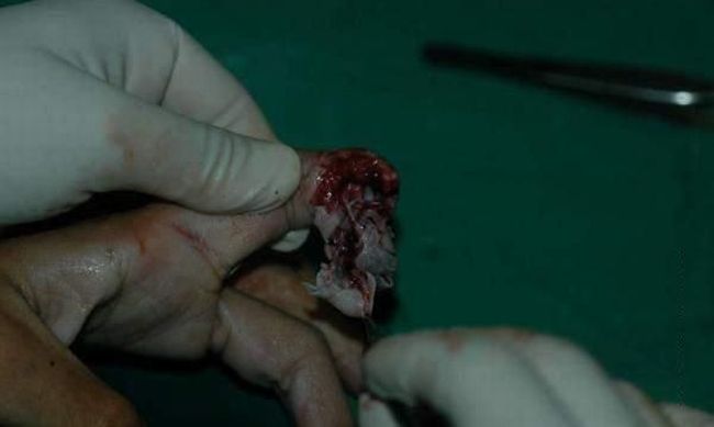 OMG. The guy was lucky that the doctors could save his finger - 01