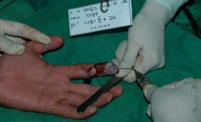 OMG. The guy was lucky that the doctors could save his finger - 03