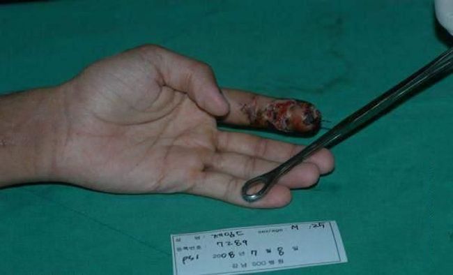 OMG. The guy was lucky that the doctors could save his finger - 05