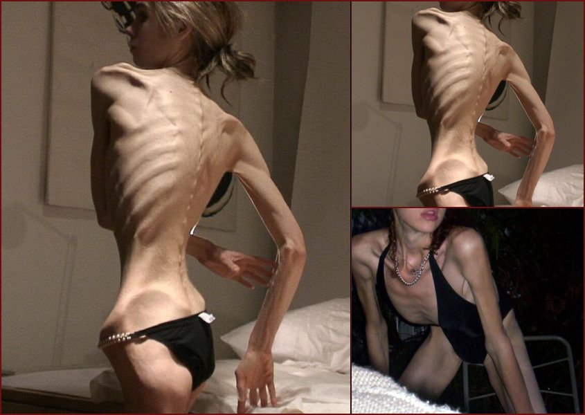 Anorexia - beauty that scares - 12