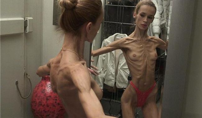 Anorexia Beauty That Scares 33 Pics