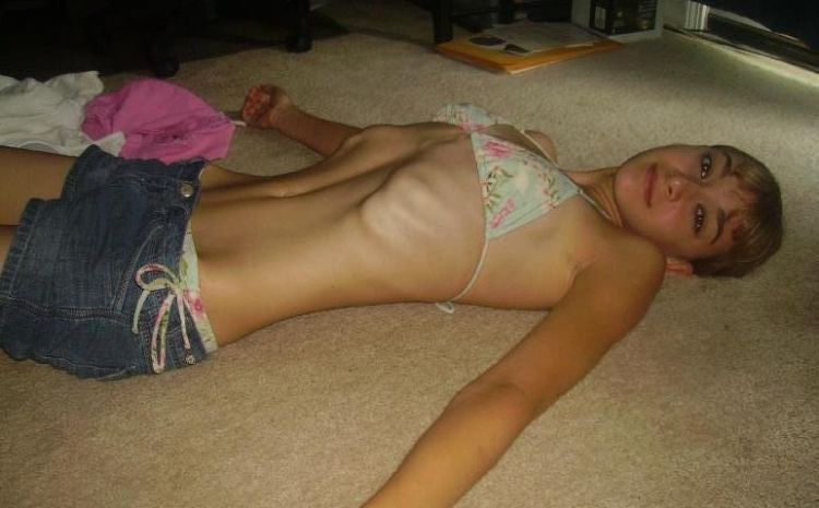Anorexia Beauty That Scares 33 Pics