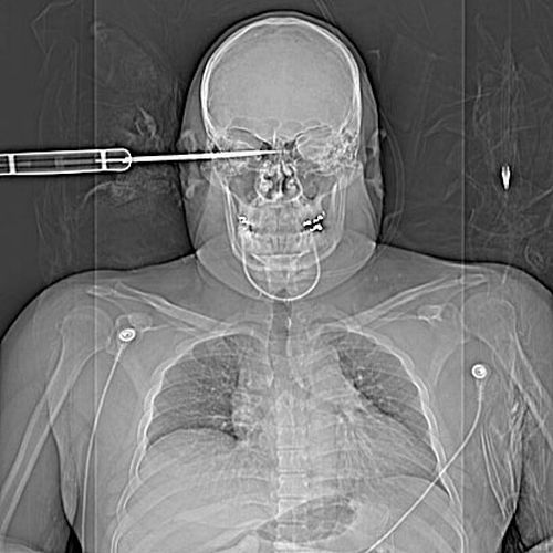 Another compilation of horrific X-Ray pictures - 21