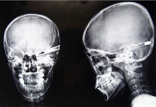 Another compilation of horrific X-Ray pictures - 36
