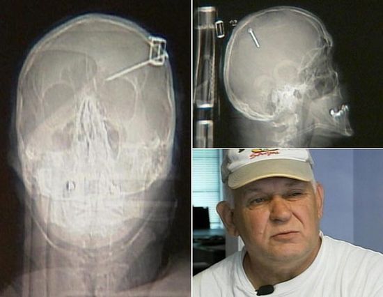 Another compilation of horrific X-Ray pictures - 41
